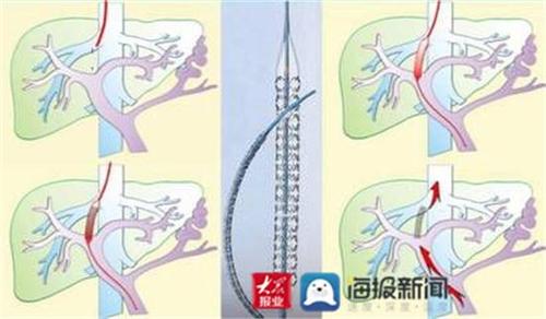 TIPS医学名词解释截图2