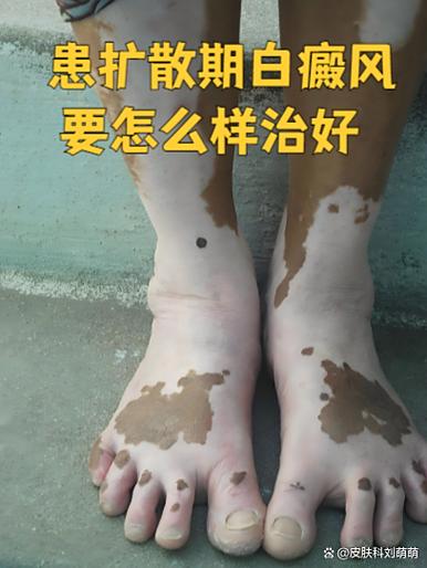 得白癜风是什么原因引起的