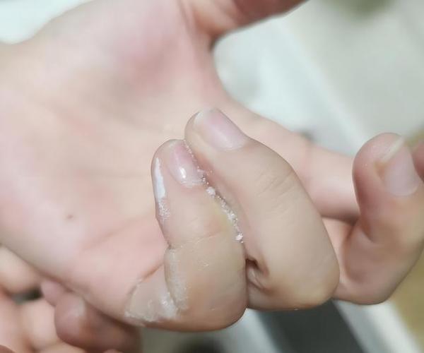 手感觉粘粘的是什么症状