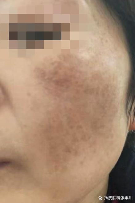 45岁女人脸上长斑怎么能去掉