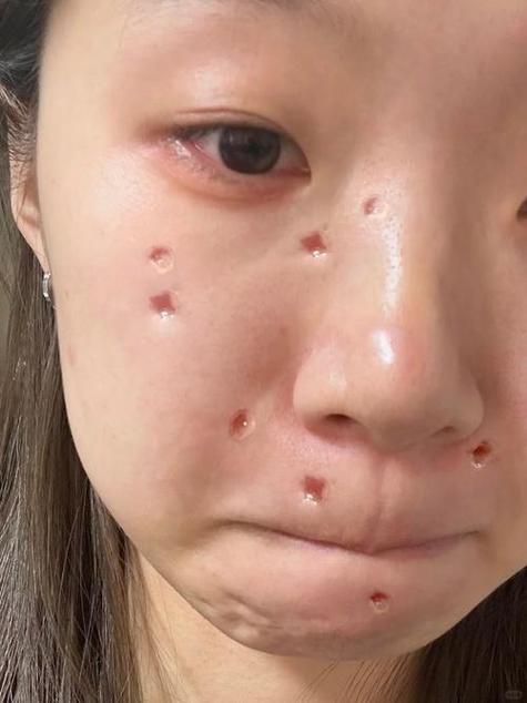 点痣落坑怎么恢复快截图1