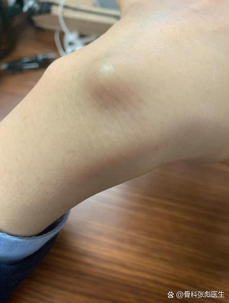 手背上长了个凸起的包