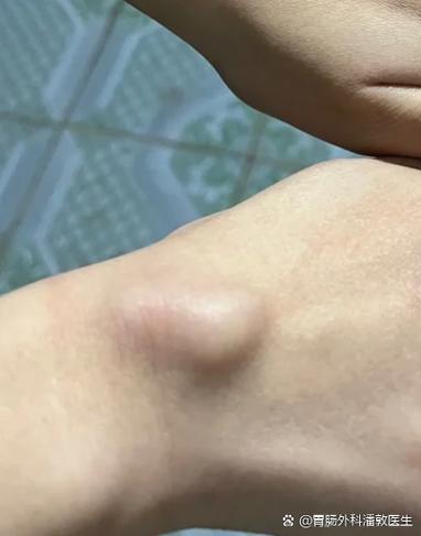 手背上长了个凸起的包截图3