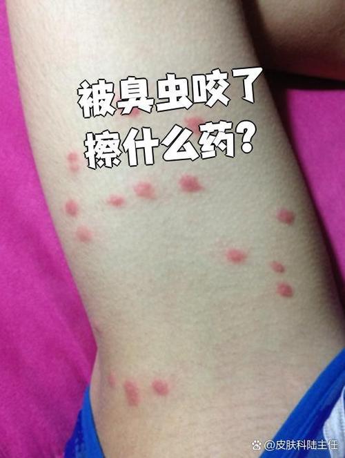 臭虫咬了用什么药好得快