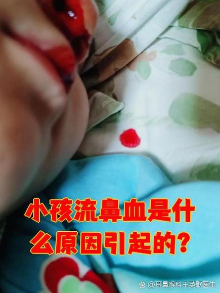 小孩发烧流鼻血是什么原因
