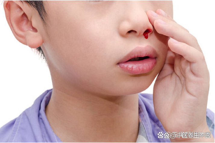 小孩上火口臭流鼻血
