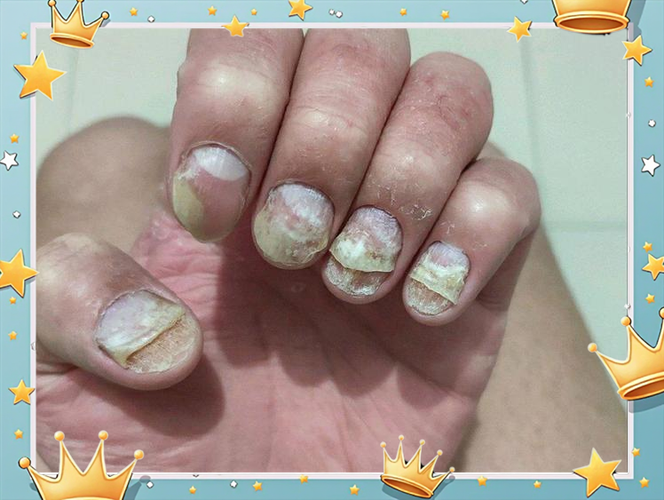 灰指甲为何喜欢大拇指