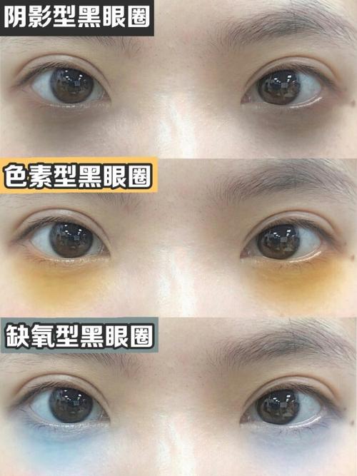 黑眼圈怎么处理