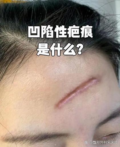脸上有凹陷的疤坑