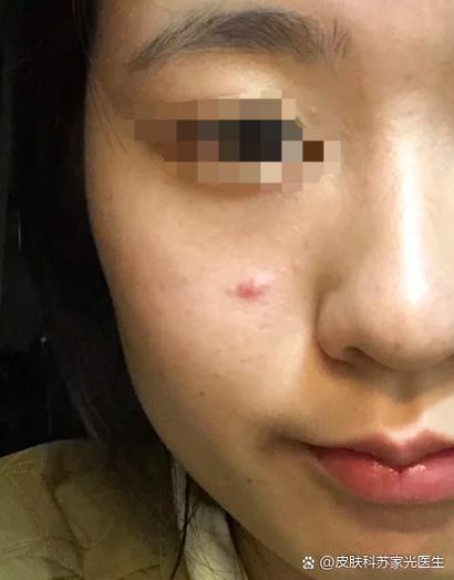 脸上长了一个红包