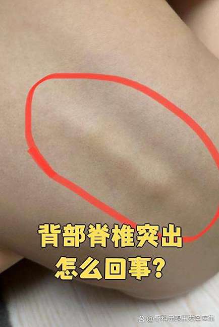 后背长了一个凸起硬包