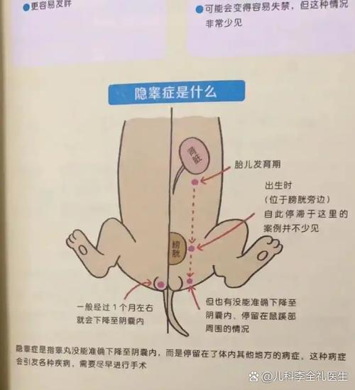 婴儿睾丸一边大一边小是什么原因
