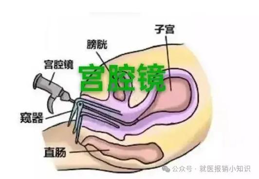 宫腔镜和腹腔镜手术一样吗 宫腔镜和腹腔镜手术一样吗