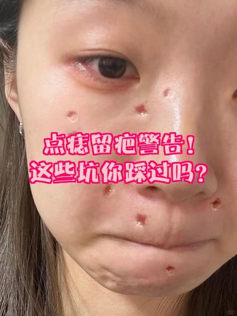 点痣落疤怎么办