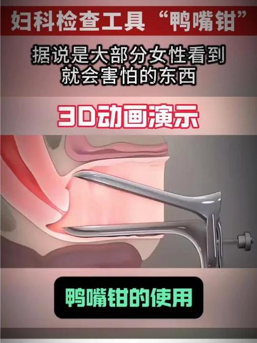 鸭嘴钳检查疼不疼
