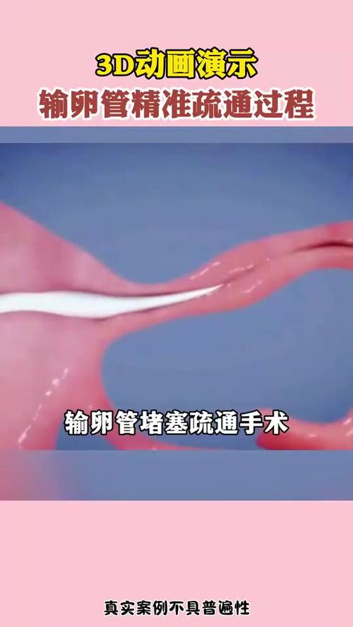 输卵管堵塞有什么办法可以疏通