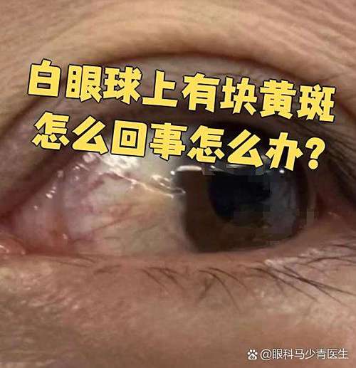 眼球黄斑病变如何治疗