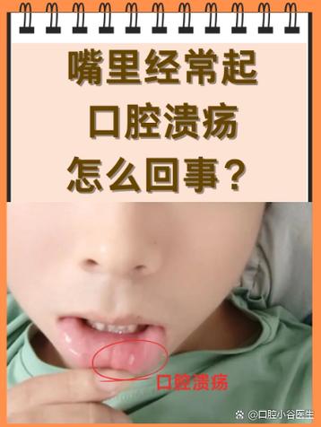 频繁的口腔溃疡是什么原因