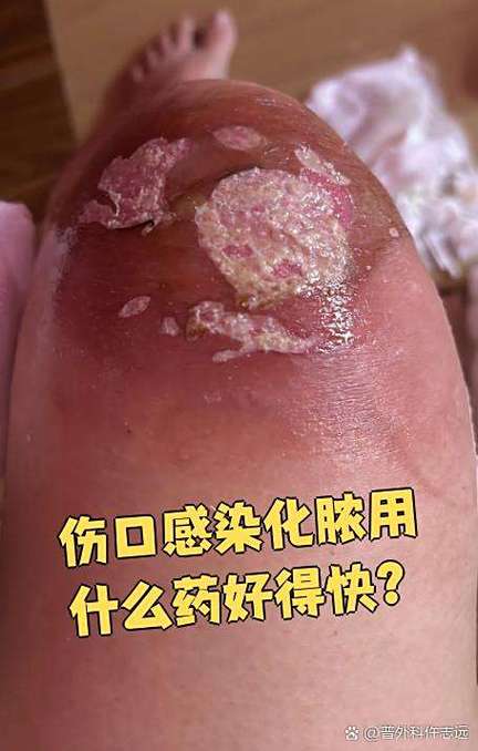 烫伤化脓了用什么药好得快