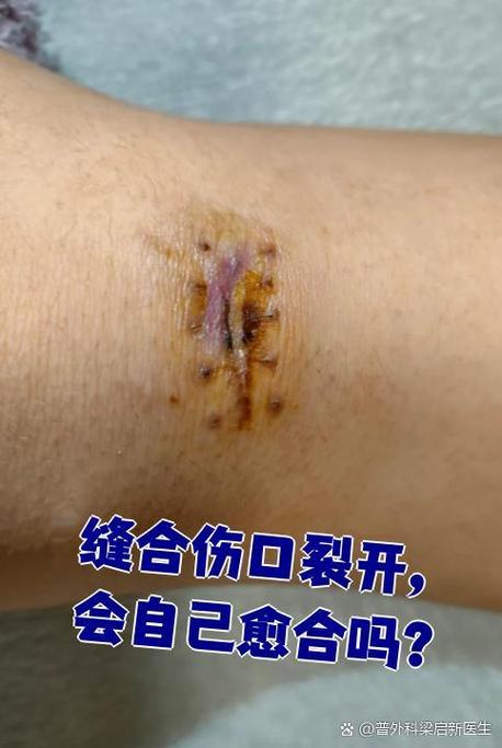 伤口会自己愈合吗