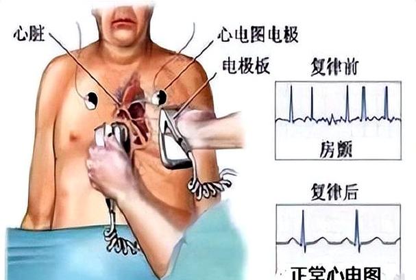 人一旦电复律就意味着什么