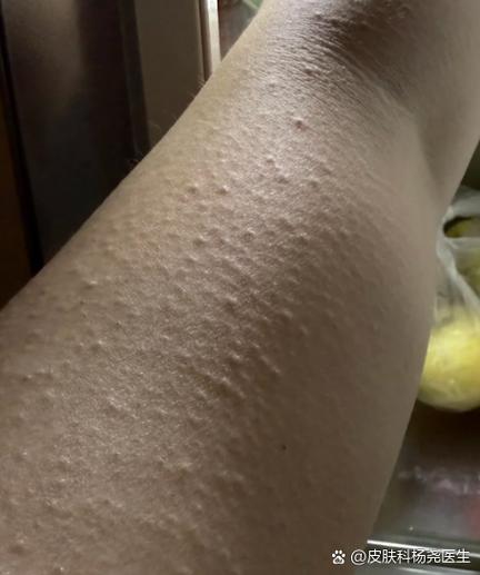 胳膊上起小疙瘩越挠越痒