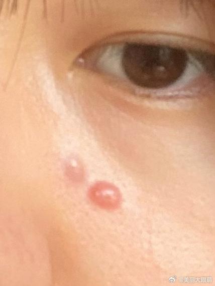 脸上起了个红包