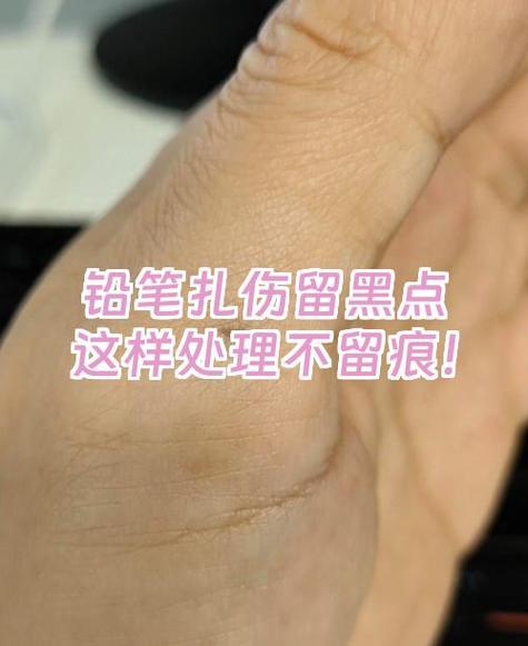 铅笔芯扎肉里了,有黑点要怎么处理