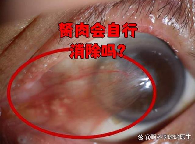 异形胬肉