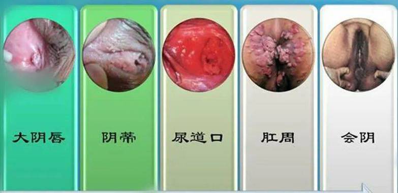 hpv感染有什么症状