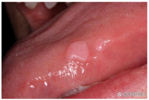68高危型hpv阳性是什么意思截图1