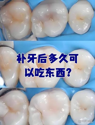 玻璃离子补牙后多久可以吃东西