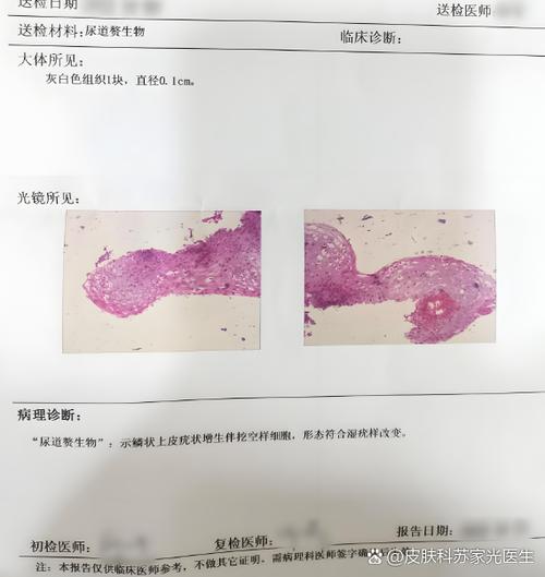 低危hpv42阳性是什么意思,严重吗