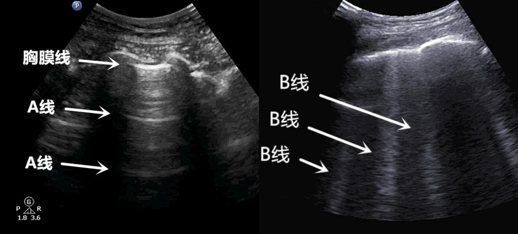 手机屏幕出现蓝线是什么情况