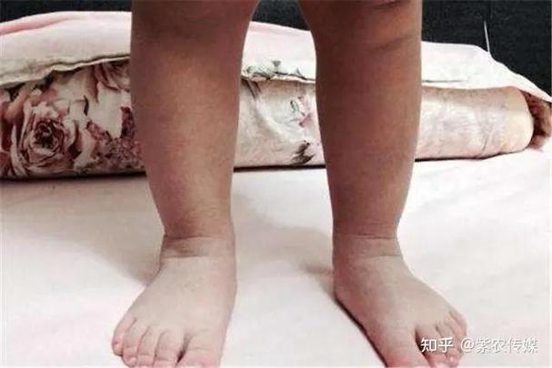 宝宝腿扭了一下走路打软