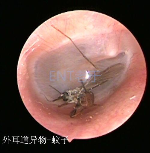 耳朵里进苍蝇没动静了