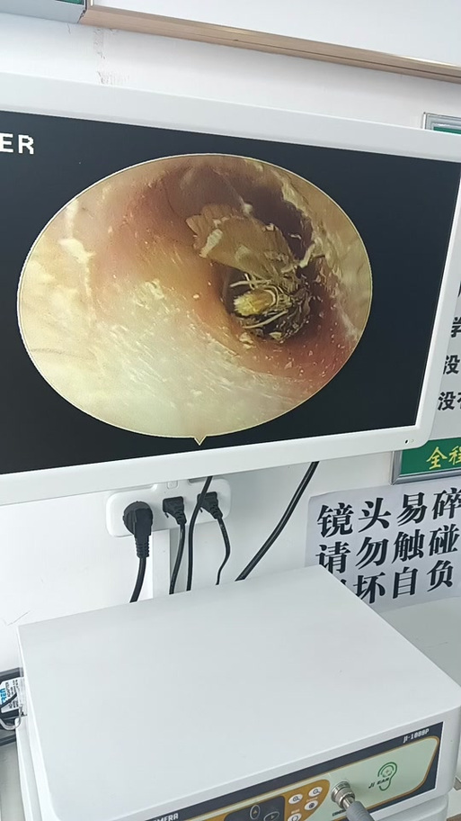 耳朵里进虫子没动静了截图2