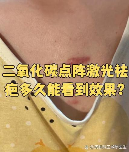 点阵激光可以去疤痕吗