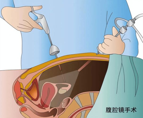 宫腹腔镜联合输卵管疏通术多少钱