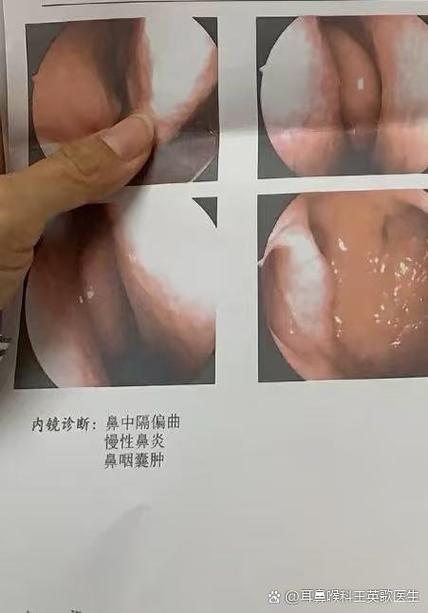 流鼻血是什么原因造成的