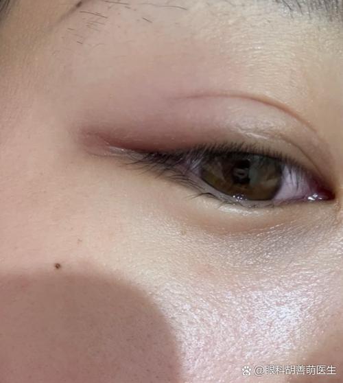 上眼皮长出一个凸起的包