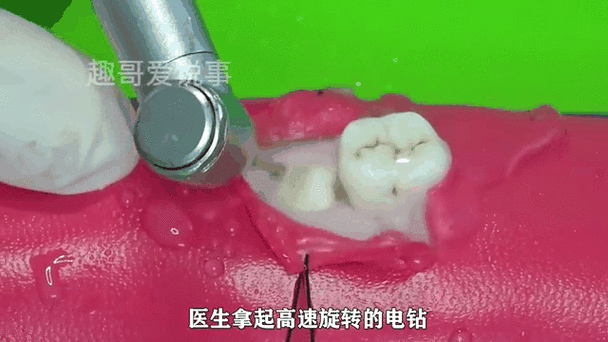 拔智齿视频