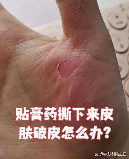膏药贴撕掉后留下胶怎么去掉