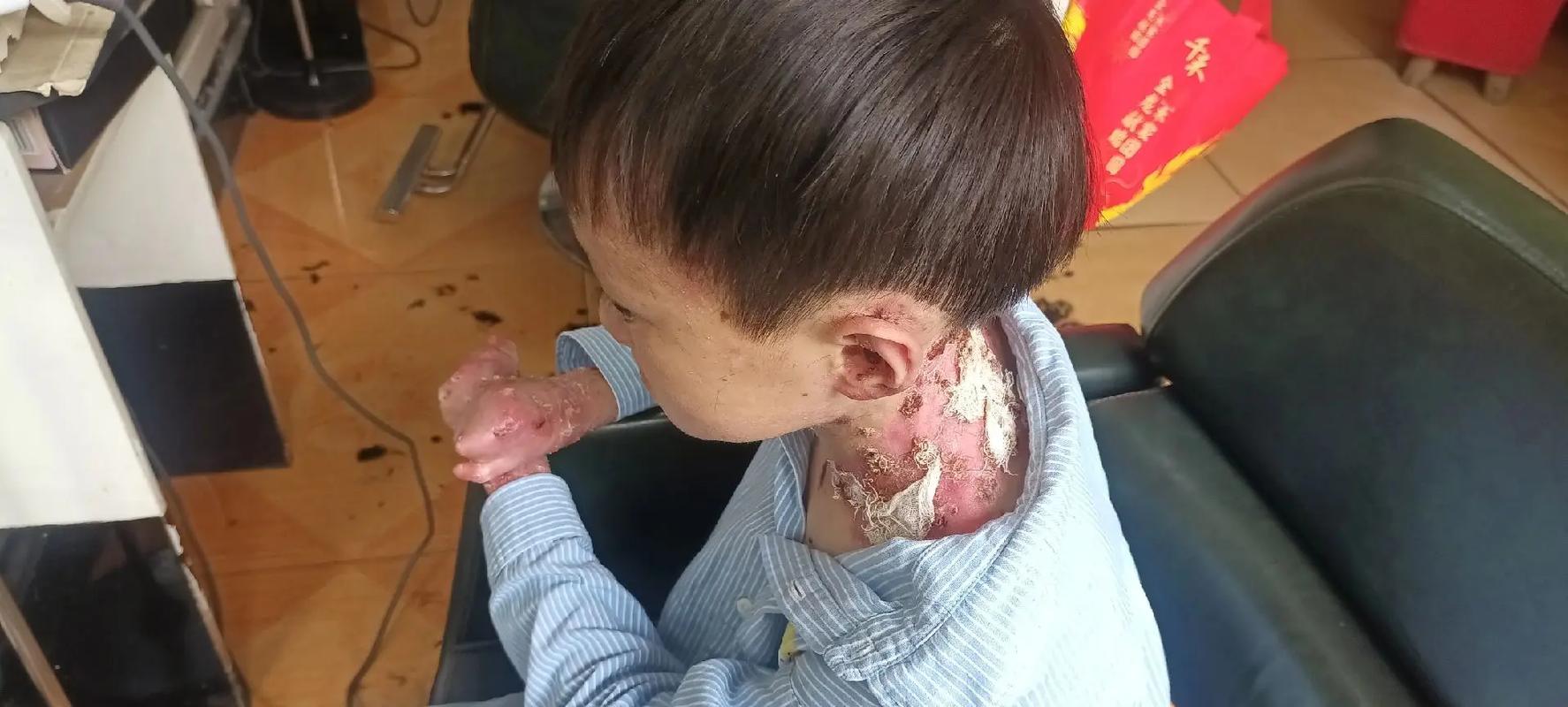 泡泡胶中毒的症状 泡泡胶中毒的症状