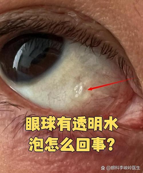 这两天眼睛老是出眼水什么原因