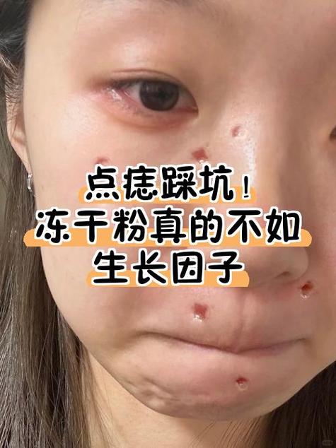 点痣留疤怎么补救