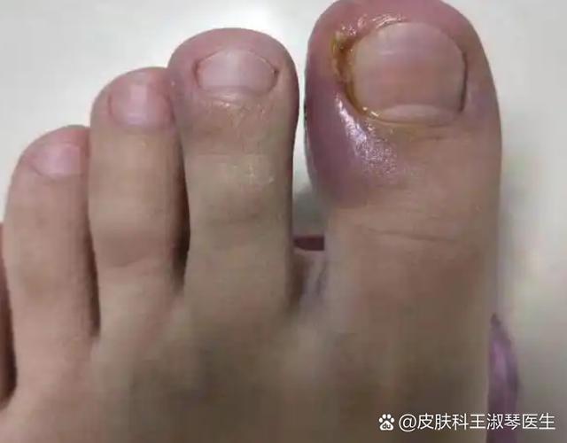 甲沟炎最佳消炎药