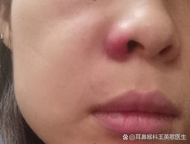 鼻子一侧疼按压有疼痛感