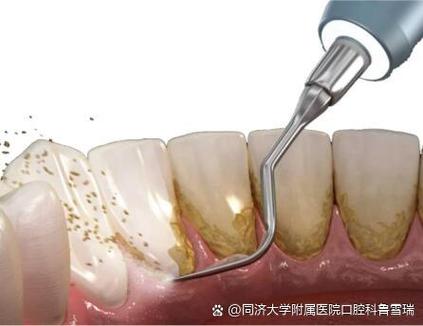 如何让松动的牙齿快速脱落