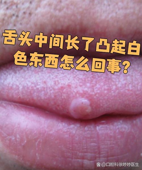 舌头上长了白色的凸起物